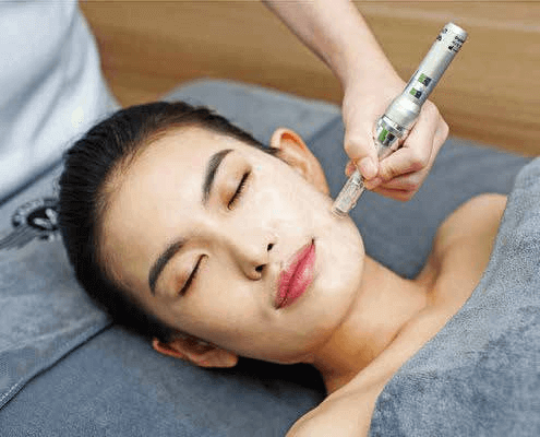 Acupuncture Microneedle Carving